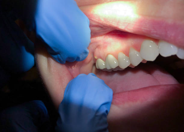 Best Emergency Denture Repair in Calverton Park, MO